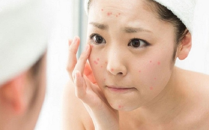 Tips chăm sóc da mụn tuổi dậy thì: Lấy lại tự tin với làn da căng bóng 8 Điều trị mụn bằng những sản phẩm chuyên dụng đến từ các thương hiệu uy tín