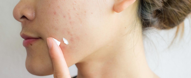 Mách bạn cách chăm sóc da mụn nhanh khỏi, tránh sẹo thâm tốt nhất 8 Dưỡng ẩm cho da có thể cân bằng lượng dầu và giúp kiểm soát mụn trứng cá