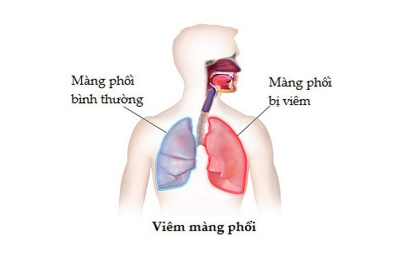 các bệnh về phổi thường gặp viêm màng phổi