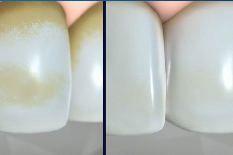 cách giữ trắng răng bằng sử dụng kem đáng răng làm trắng