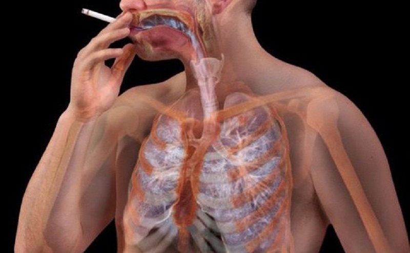 Hút thuốc lá gây ung thư phổi