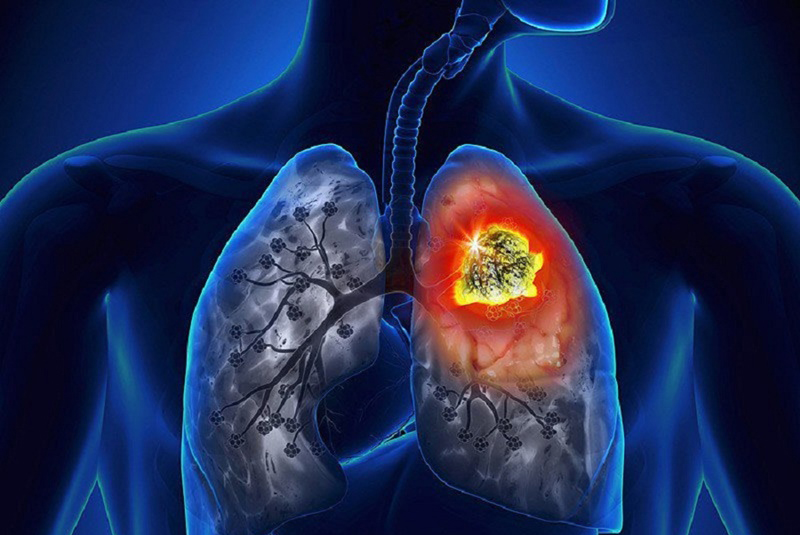 dấu hiệu bệnh phổi bạn nên biết