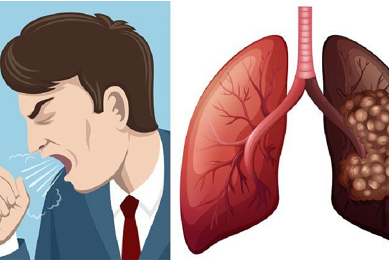 dấu hiệu bệnh phổi thường gặp bạn cần nắm
