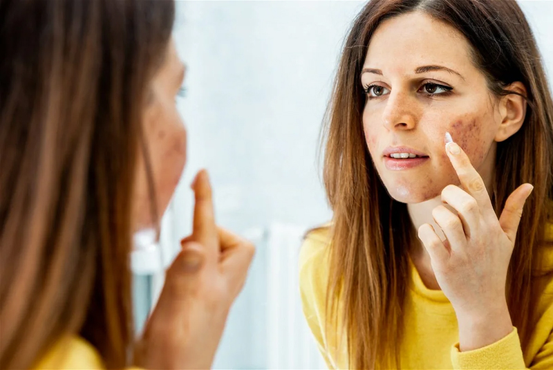 Khái niệm nám da, cách phân loại và điều trị hiệu quả 7 nám da là gì