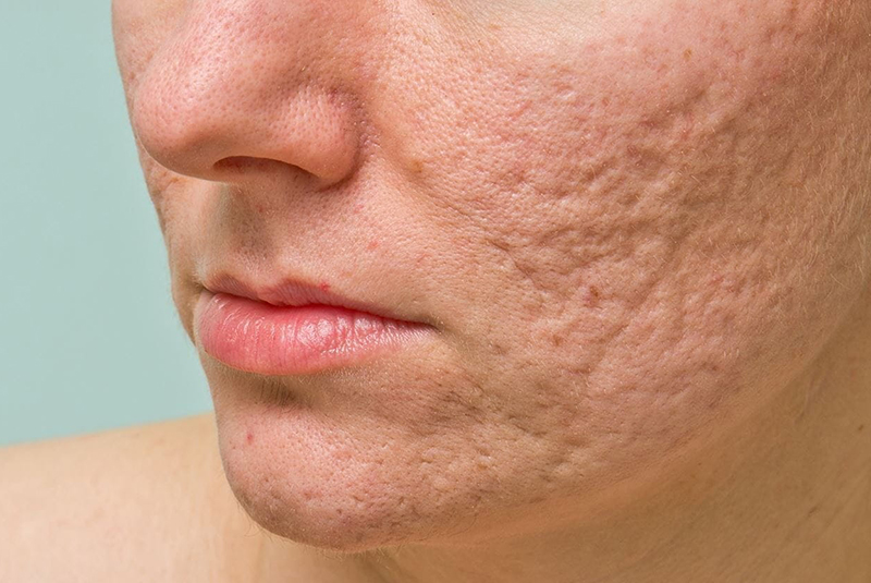 Sẹo rỗ là gì ? Vitamin E trị sẹo rỗ có được không? 10 sẹo rỗ là gì